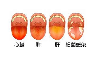 現在伸出你的舌頭就能快速檢測「身體哪裡有毛病」，紫色舌頭的疾病實在太糟糕了