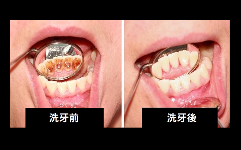 Mobile 為何洗完齒縫越變越大還很酸 搞懂這三大洗牙迷思 讓你從此不再害怕看牙