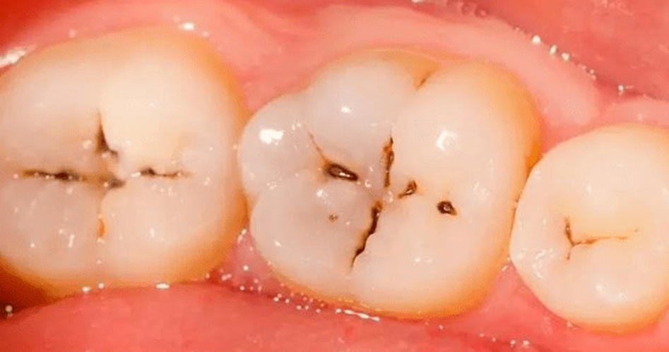 牙齒上的小黑斑「為什麼刷不乾淨也摳不掉」？牙醫告訴你真相！